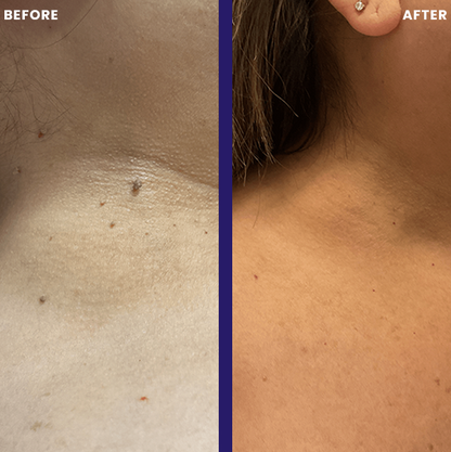 TagPal Skin Tag Remover