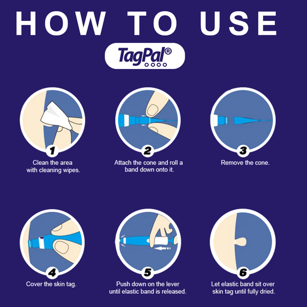 TagPal Skin Tag Remover